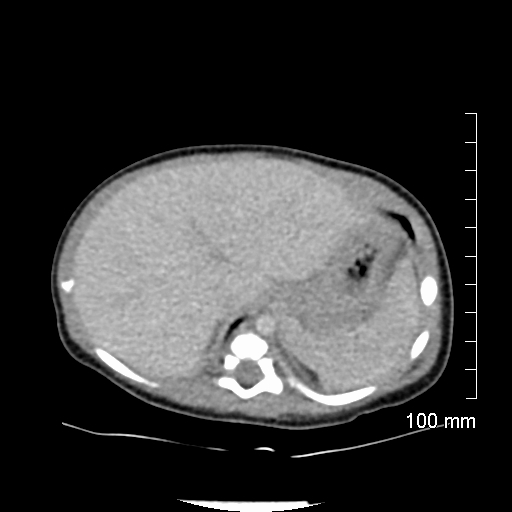 File:Neonatal neuroblastoma (Radiopaedia 56651-63438 Axial non-contrast 20).jpg