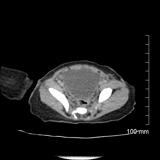 File:Neonatal neuroblastoma (Radiopaedia 56651-63438 Axial non-contrast 69).jpg