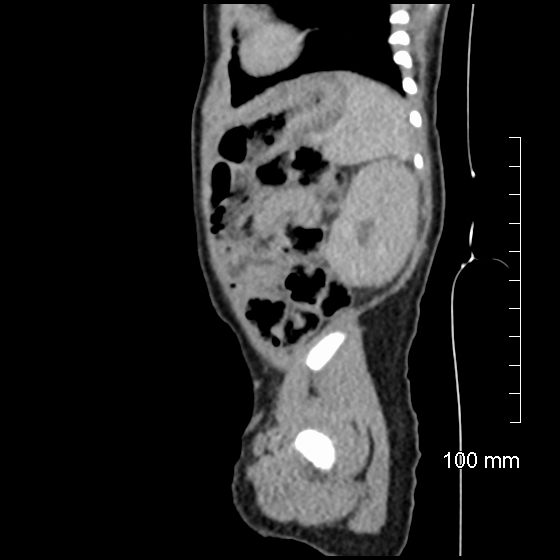 File:Neonatal neuroblastoma (Radiopaedia 56651-63438 C 25).jpg