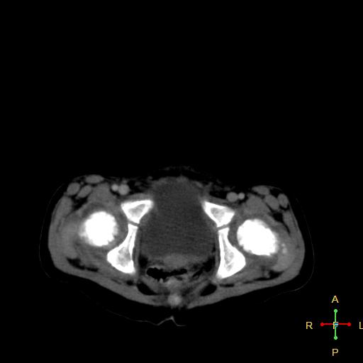 File:Neuroblastoma (Radiopaedia 24751-25016 D 43).jpg