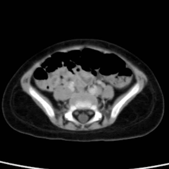 Neuroblastoma with skull metastases (Radiopaedia 30326-30960 C 44).jpg