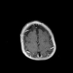 File:Neurofibromatosis type 1 (Radiopaedia 30089-30671 Axial T1 C+ 21).jpg