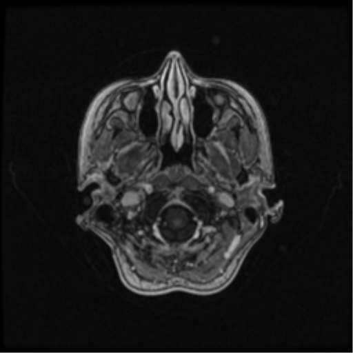 Neurofibromatosis type 2 (Radiopaedia 45229-49244 Axial T1 C+ 26).png