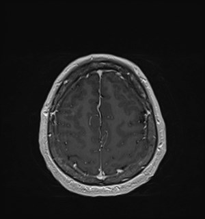 Neurofibromatosis type 2 (Radiopaedia 79097-92049 Axial T1 C+ 162).jpg