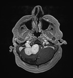 Neurofibromatosis type 2 (Radiopaedia 79097-92049 Axial T1 C+ 42).jpg