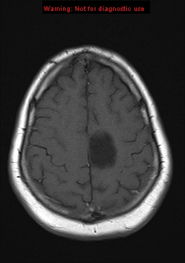 File:Neuroglial cyst (Radiopaedia 10713-11184 Axial T1 5).jpg
