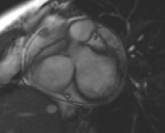 File:Non-compaction of the left ventricle (Radiopaedia 69436-79314 Short axis cine 190).jpg