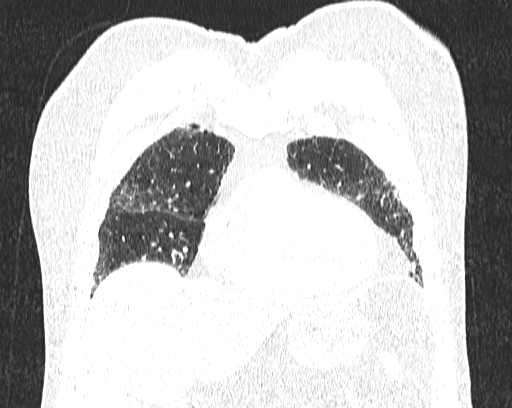 Non-specific interstitial pneumonia (NSIP) (Radiopaedia 68599-78228 Coronal lung window 19).jpg