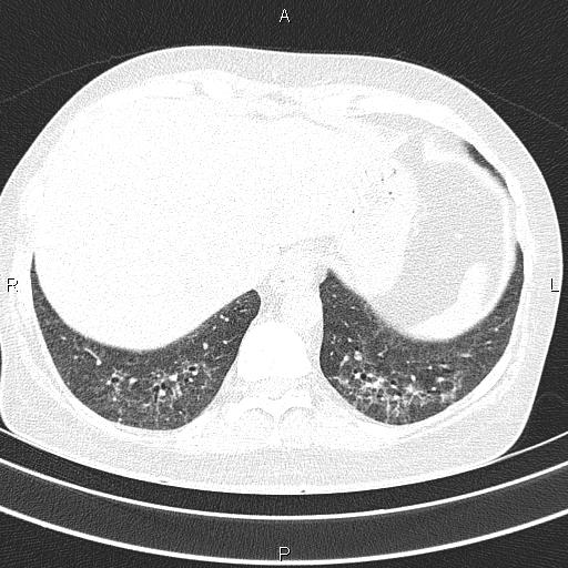Non-specific interstitial pneumonia (Radiopaedia 83185-97567 Axial lung window 53).jpg