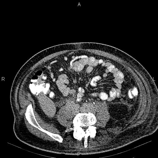 Non Hodgkin lymphoma in a patient with ankylosing spondylitis (Radiopaedia 84323-99621 Axial C+ delayed 48).jpg