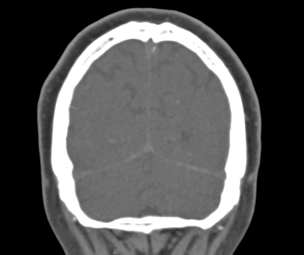 File:Normal CTA head (Radiopaedia 40801-43464 B 79).png