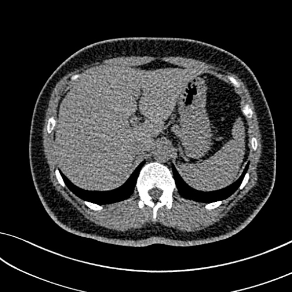Normal CT chest- adult female (Radiopaedia 52522-58428 Axial non-contrast 123).jpg