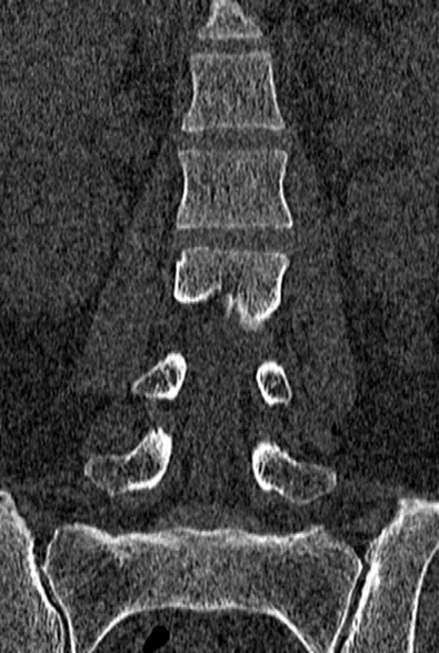 Normal CT lumbar spine (Radiopaedia 53981-60118 Coronal bone window 30).jpg