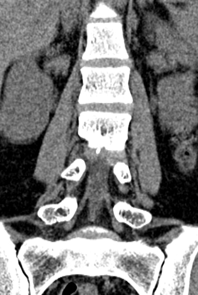 Normal CT lumbar spine (Radiopaedia 53981-60118 F 40).jpg