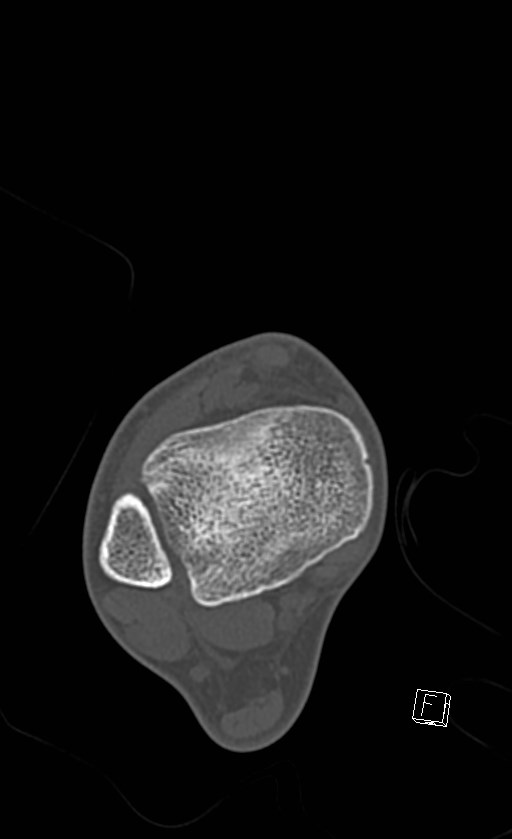 Normal CT of the ankle (Radiopaedia 47111-51658 Axial bone window 32).jpg