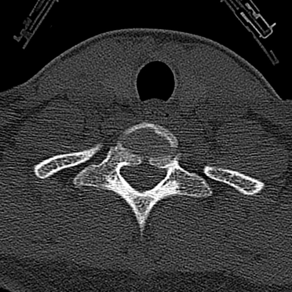 Normal CT of the cervical spine (Radiopaedia 53322-59305 Axial bone window 224).jpg