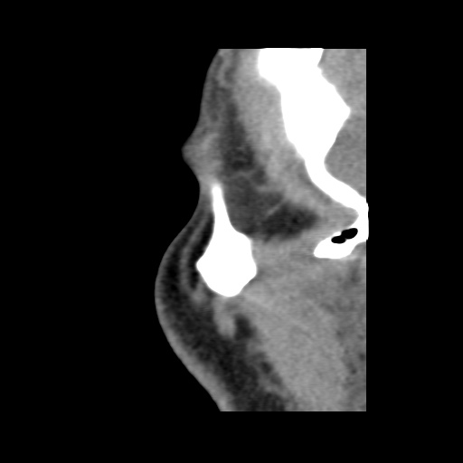 Normal CT paranasal sinuses (Radiopaedia 42286-45390 F 134).jpg