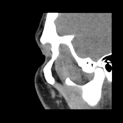 Normal CT paranasal sinuses (Radiopaedia 42286-45390 F 31).jpg