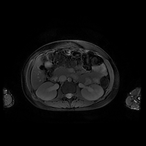 File:Normal MRI abdomen in pregnancy (Radiopaedia 88001-104541 D 22).jpg