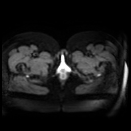 Normal MRI abdomen in pregnancy (Radiopaedia 88005-104548 Axial DWI 1).jpg