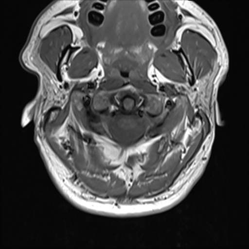 File:Normal MRI cervical spine (infection protocol) (Radiopaedia 53916-60039 Axial 10).png