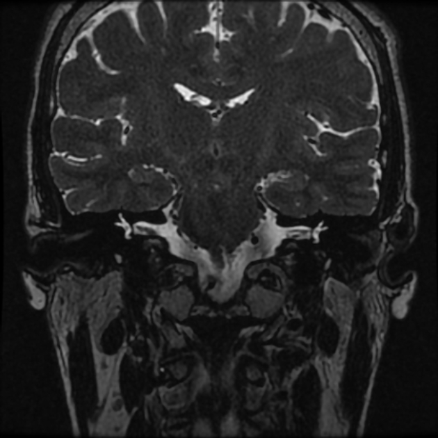 Normal MRI petrous (Radiopaedia 91317-108949 Coronal T2 48).jpg