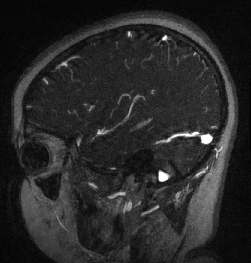 Normal brain MRI and venogram (Radiopaedia 39554-41862 Sagittal MRV 16).jpg