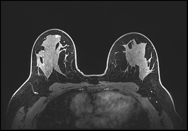 Normal breast MRI - dense breasts (Radiopaedia 80454-93850 C 130).jpg