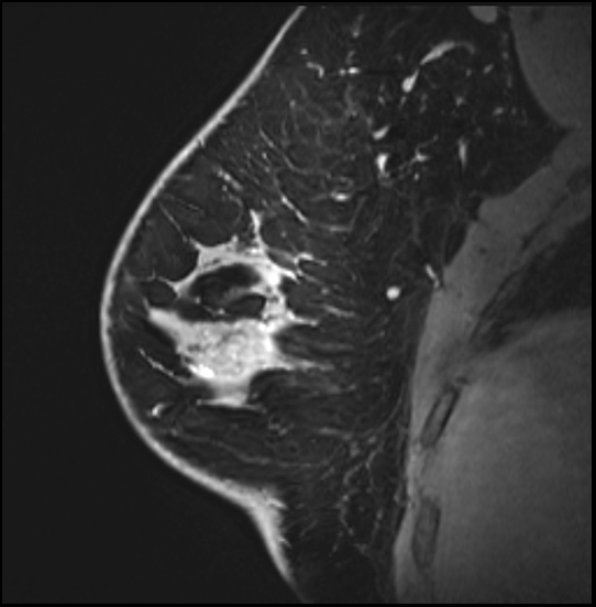 Normal breast MRI - dense breasts (Radiopaedia 80454-93850 I 57).jpg