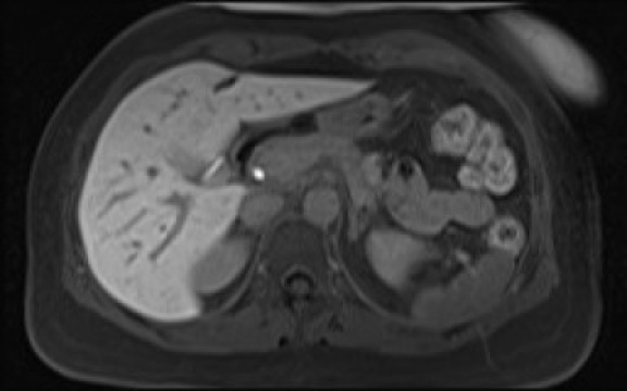 File:Normal hepatobiliary phase liver MRI (Radiopaedia 58968-66230 A 43).jpg