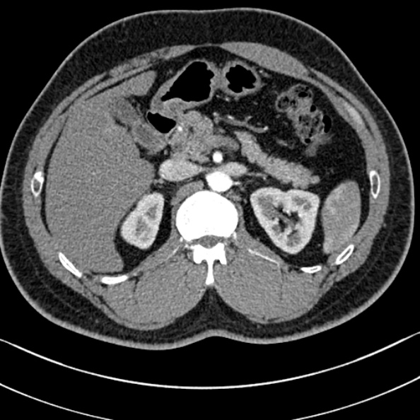 Normal kidneys on 4-phase CT study (Radiopaedia 25889-26038 B 20).jpg