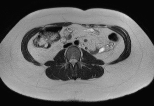 File:Normal liver MRI with Gadolinium (Radiopaedia 58913-66163 Axial T2 3).jpg