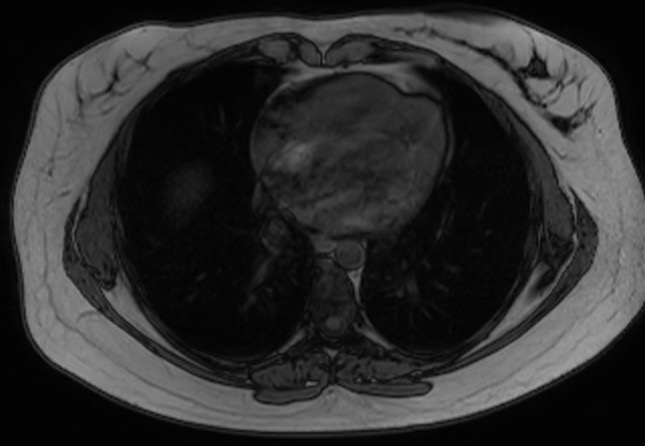 File:Normal liver MRI with Gadolinium (Radiopaedia 58913-66163 B 33).jpg