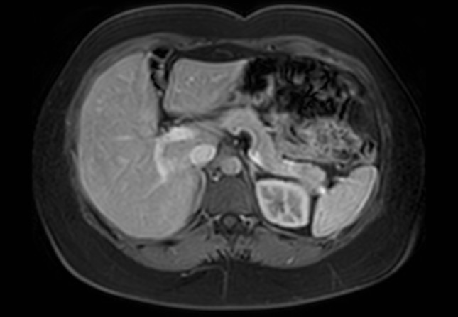 Normal liver MRI with Gadolinium (Radiopaedia 58913-66163 J 44).jpg