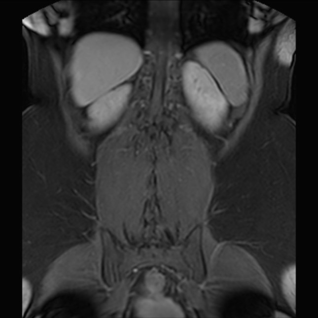 Normal liver MRI with Gadolinium (Radiopaedia 58913-66163 P 69).jpg