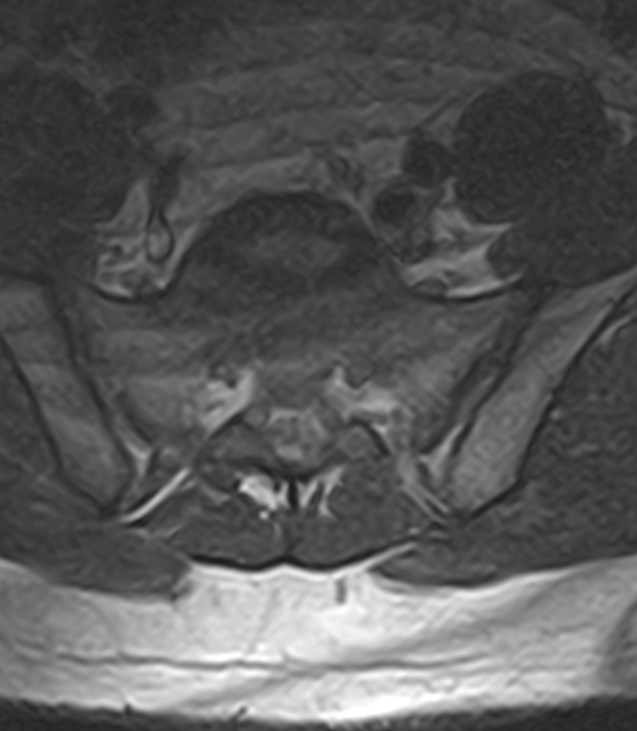 Normal lumbar spine MRI - low-field MRI scanner (Radiopaedia 40976-43699 Axial T2 93).jpg