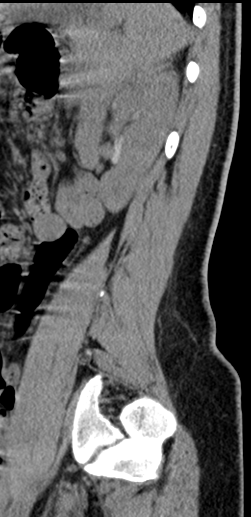 Normal lumbosacral CT (Radiopaedia 37923-39867 E 25).png
