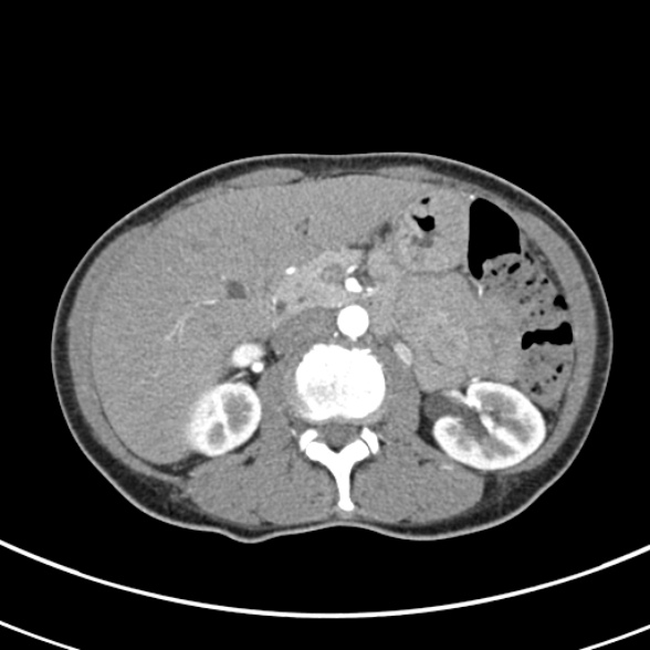 File:Normal multiphase CT liver (Radiopaedia 38026-39996 B 33).jpg