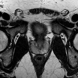 File:Normal prostate (MRI) (Radiopaedia 29986-30535 Axial T2 8).jpg