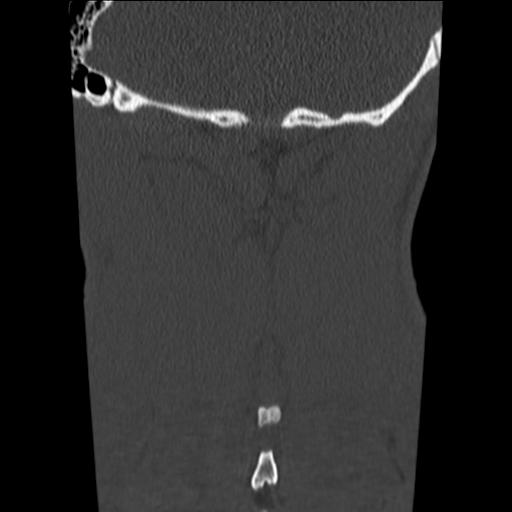 File:Normal trauma cervical spine (Radiopaedia 41017-43760 Coronal bone window 43).png