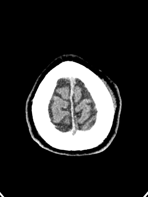 Normal trauma protocol brain and C-spine CT (Radiopaedia 83302-97709 Axial non-contrast 12).jpg