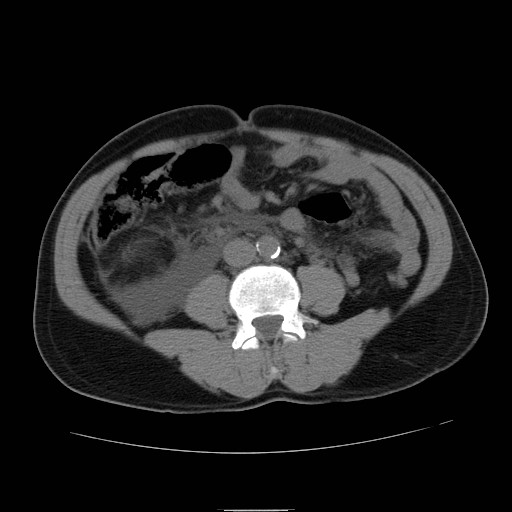 File:Obstructed kidney with perinephric urinoma (Radiopaedia 26889-27066 Axial non-contrast 34).jpg