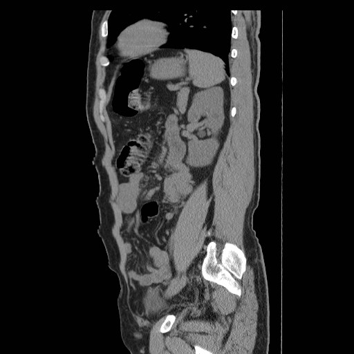 File:Obstructed kidney with perinephric urinoma (Radiopaedia 26889-27066 B 48).jpg