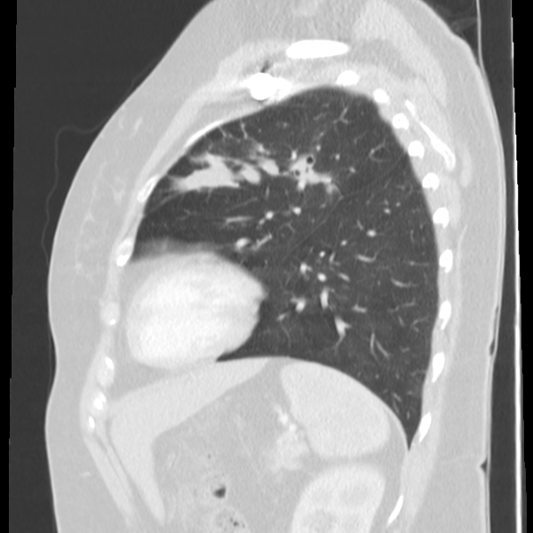Obstructing typical carcinoid causing bronchoceles (Radiopaedia 50149-55476 Sagittal lung window 43).png