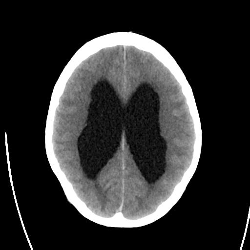 File:Obstructive hydrocephalus (Radiopaedia 30453-31119 Axial non-contrast 18).jpg
