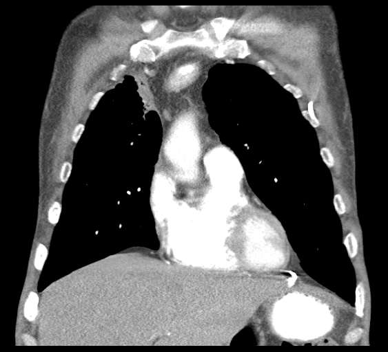 File:Obstructive superior vena cava tumor thrombus (Radiopaedia 28046-28306 B 15).jpg