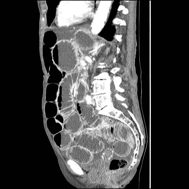 Obturator hernia causing small bowel obstruction (Radiopaedia 65522-74612 C 43).jpg