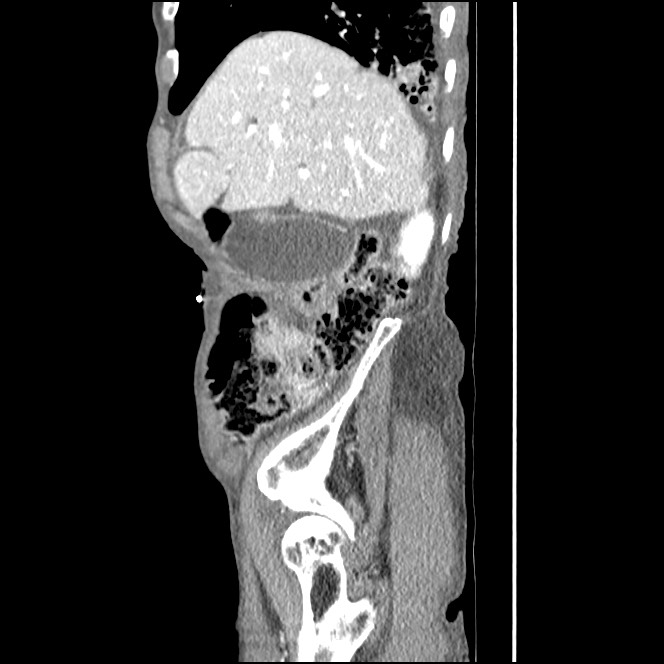Obturator hernia causing small bowel obstruction (Radiopaedia 65522-74612 C 79).jpg