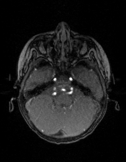 Occipital horn syndrome (Radiopaedia 14255-14129 MRA 37).jpg