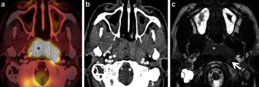 a) Axial PET/CT image reveals a FDG-avid mass in the nasopharynx in keeping with a known nasopharyngeal carcinoma b)axial CECT image shows the infiltrative nasopharyngeal carcinoma c) axial T2W MR image demonstrates the infiltrative nasopharyngeal carcinoma
